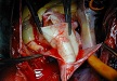 Řešení regurgitace aortální chlopně u nemocného s disekcí Stanford A