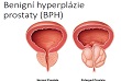 5. BPH, prostatitida, benigní onemocnění mužského genitalu, uretritidy