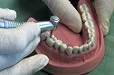Amalgámová výplň na žvýkacích plochách molárů a premolárů