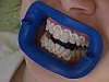 Bělení zubů pomocí peroxidu