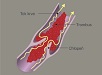Hluboká žilní trombóza a plicní embolie - diagnostika a léčba