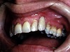 Klinické sledování a postup ošetření u zubů s vnitřním granulomem