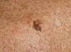 Kožní eflorescence, klinické dermatologické vyšetření