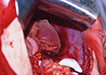Poranění parenchymových orgánů dutiny břišní