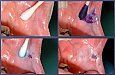 Prekancerózy v dutině ústní